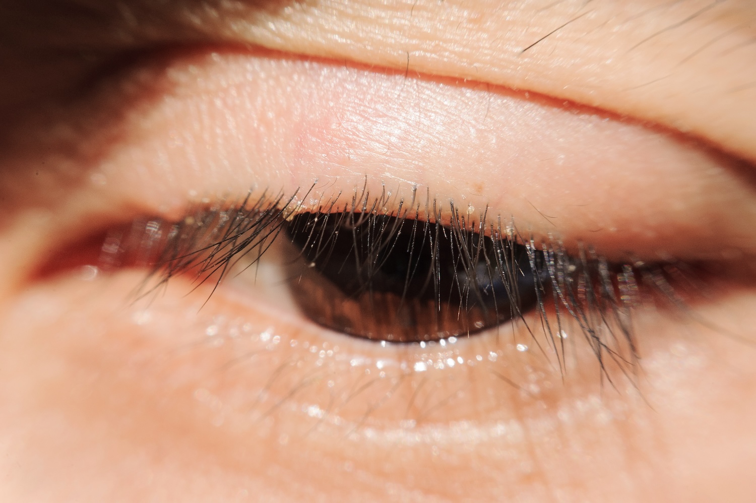 close up of eye with blepharitis